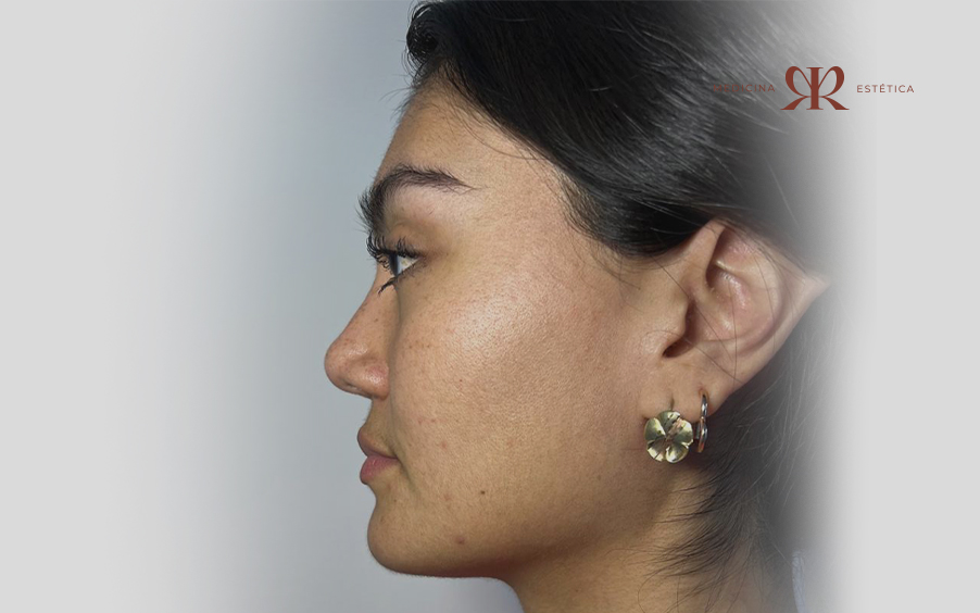 Después del tratamiento facial